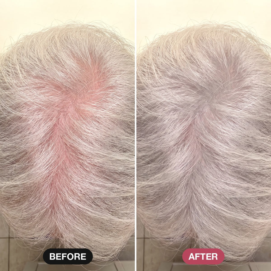 White hair, pink scalp at the crown